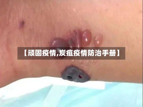【顽固疫情,炭疽疫情防治手册】
