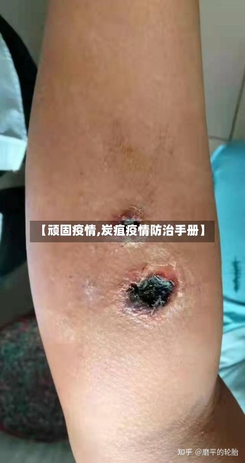 【顽固疫情,炭疽疫情防治手册】-第3张图片